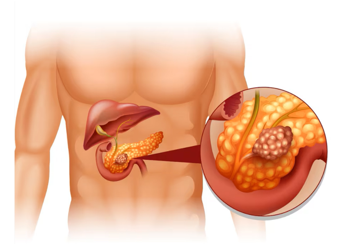Tumori Neuroendocrini